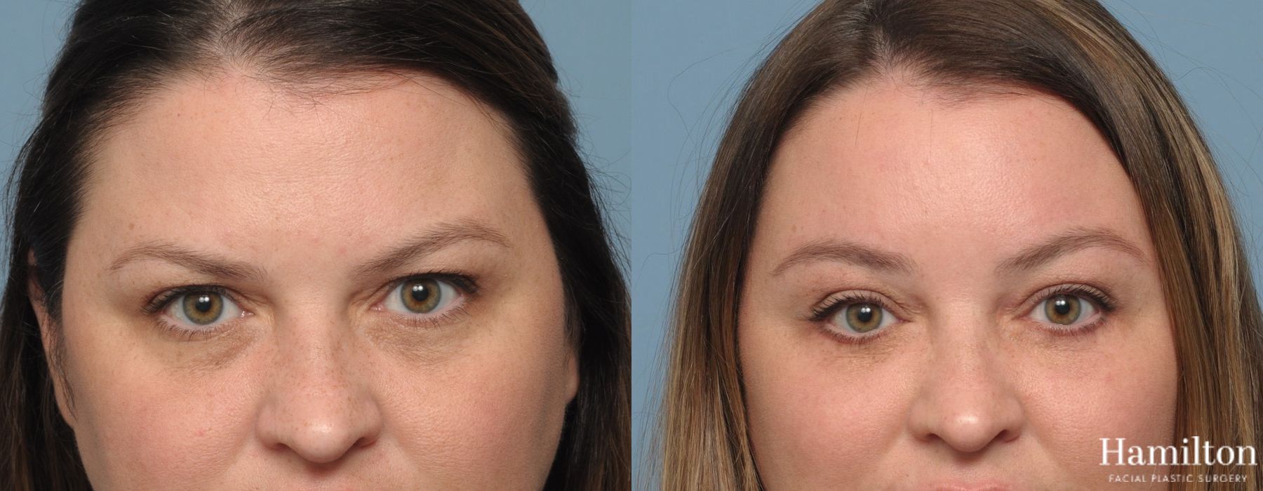 Before and after Brow Lift case 37086
