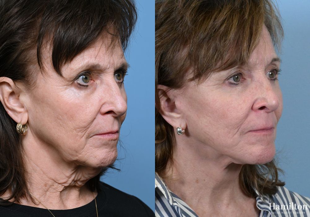 Before and after Facelift case 37338