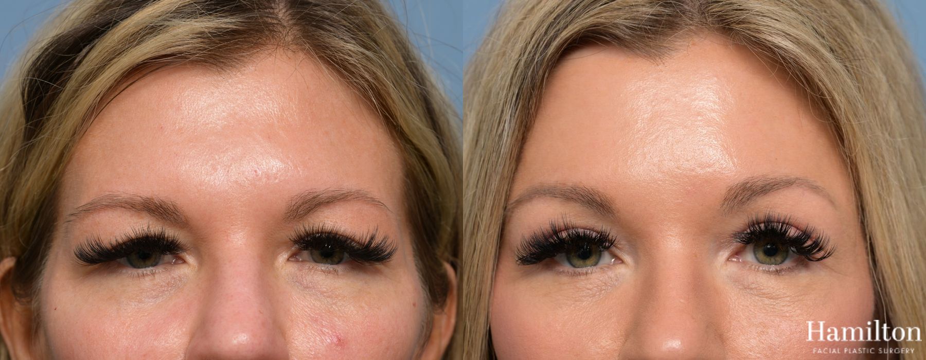 Before and after Blepharoplasty case 37156