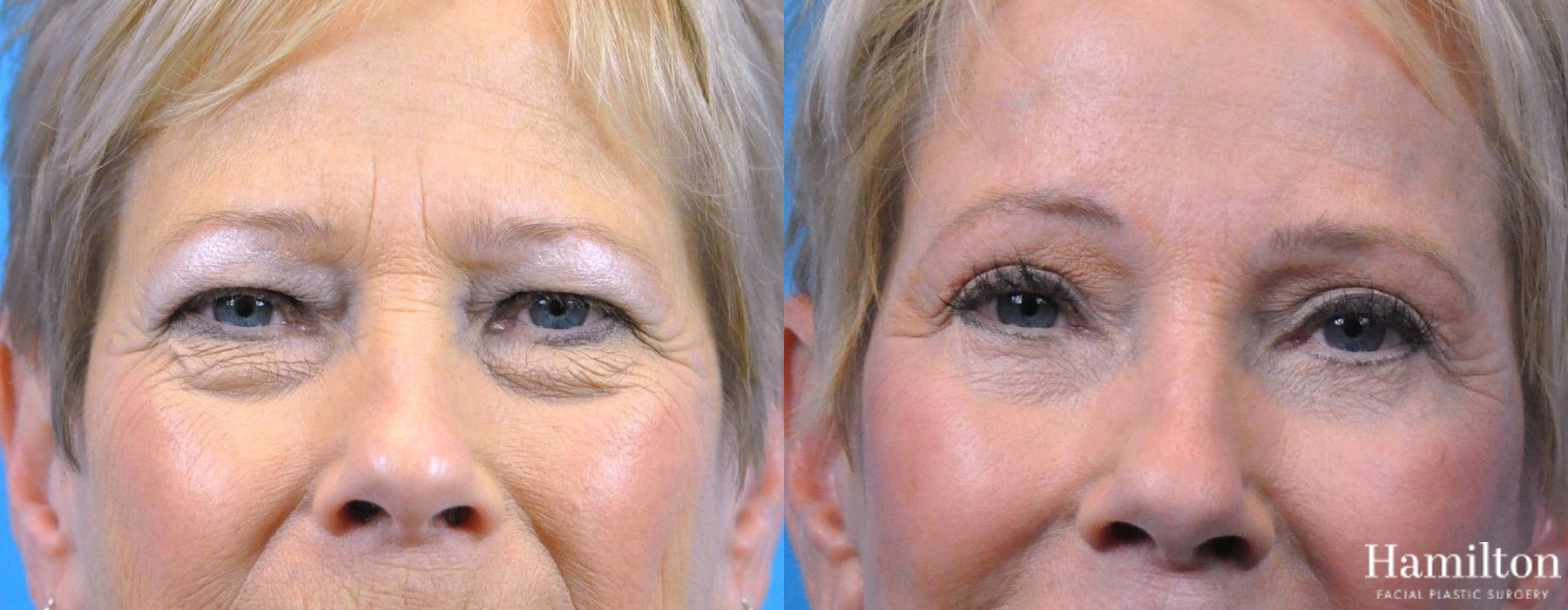 Before and after Blepharoplasty case 37088