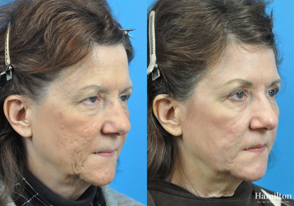 Before and after Laser - CO2 case 37249