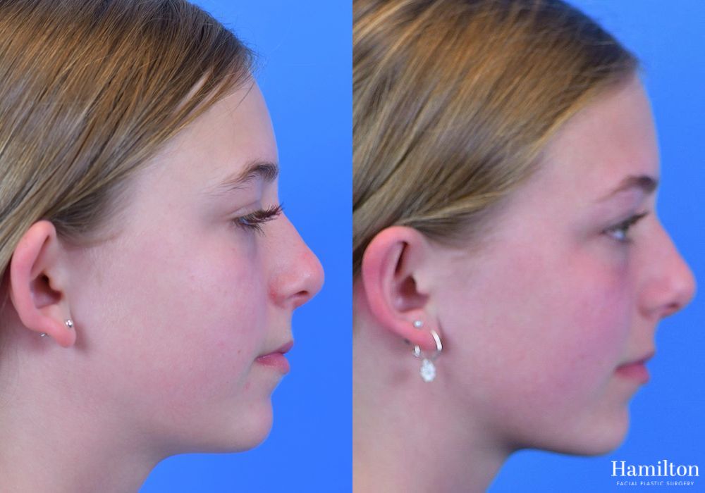 Before and after Otoplasty case 37365 - Angle 4