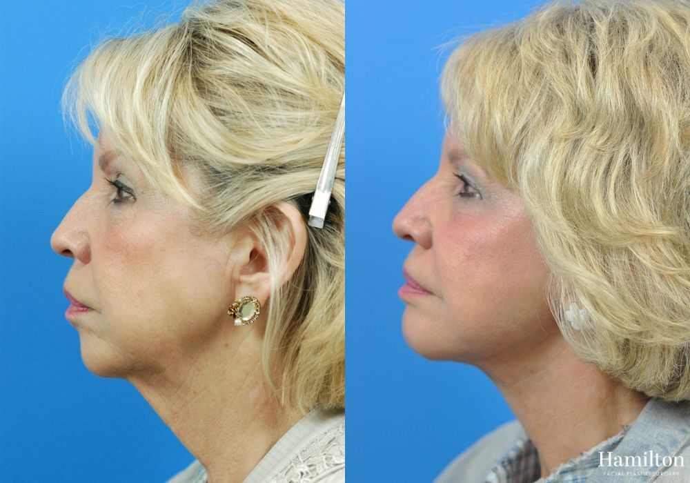 Before and after Neck Rejuvenation case 37217 - Angle 3