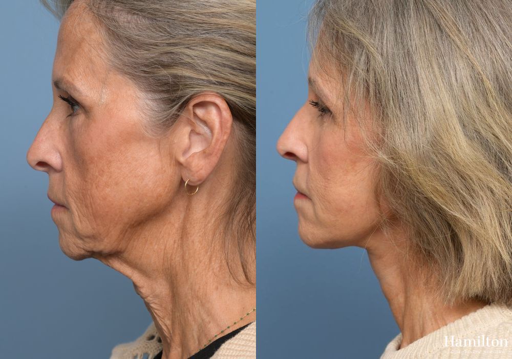 Before and after Facelift case 37219 - Angle 5