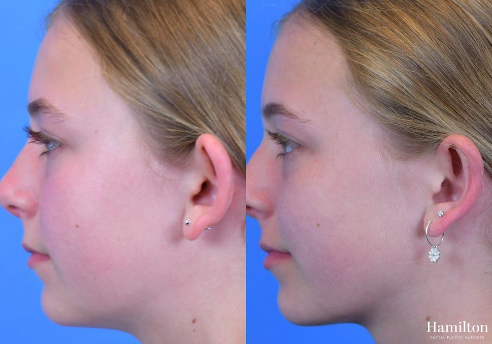 Before and after Otoplasty case 37365 - Angle 3