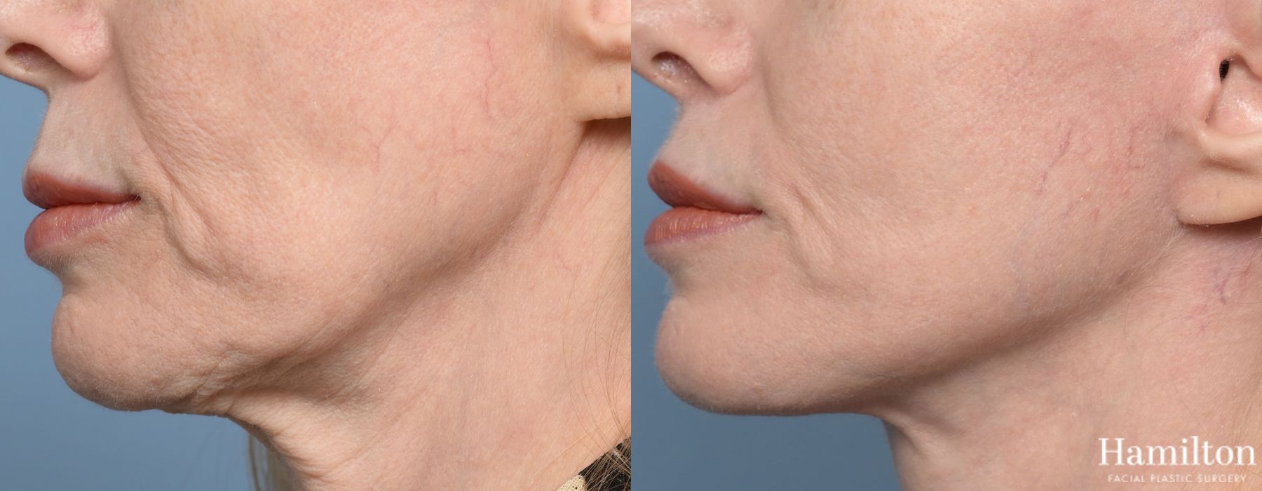Before and after Lip Lift case 37100 - Angle 4