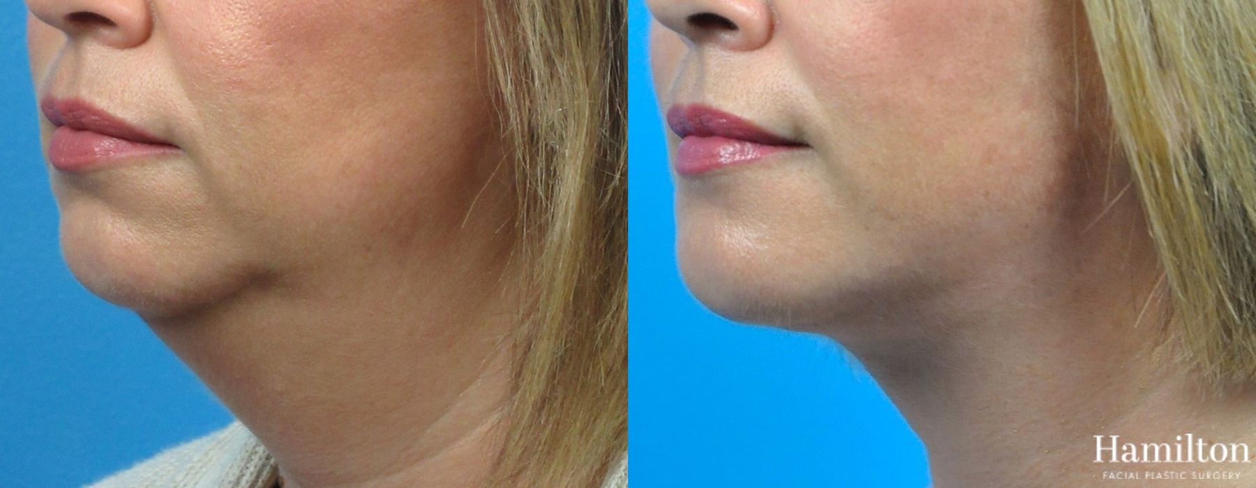 Before and after Neck Rejuvenation case 37187 - Angle 3