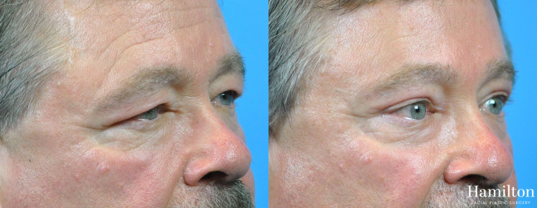 Before and after Blepharoplasty case 37319