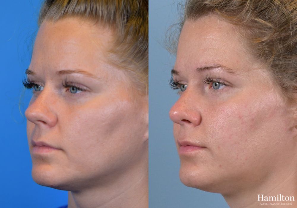 Before and after Rhinoplasty case 37359 - Angle 2