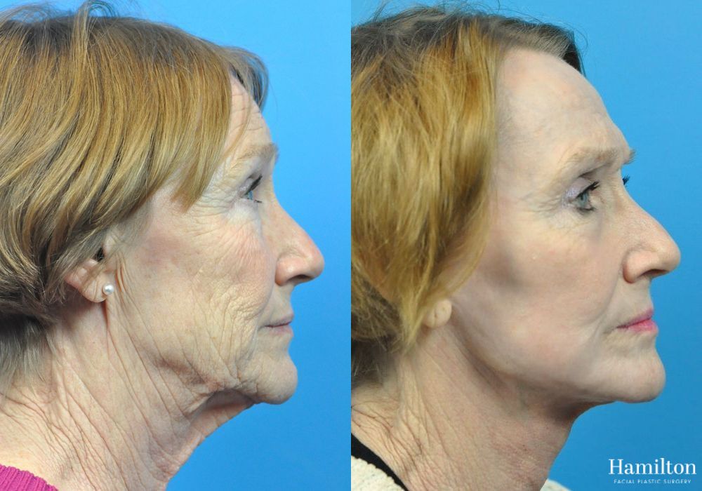 Before and after Laser - CO2 case 37231 - Angle 2