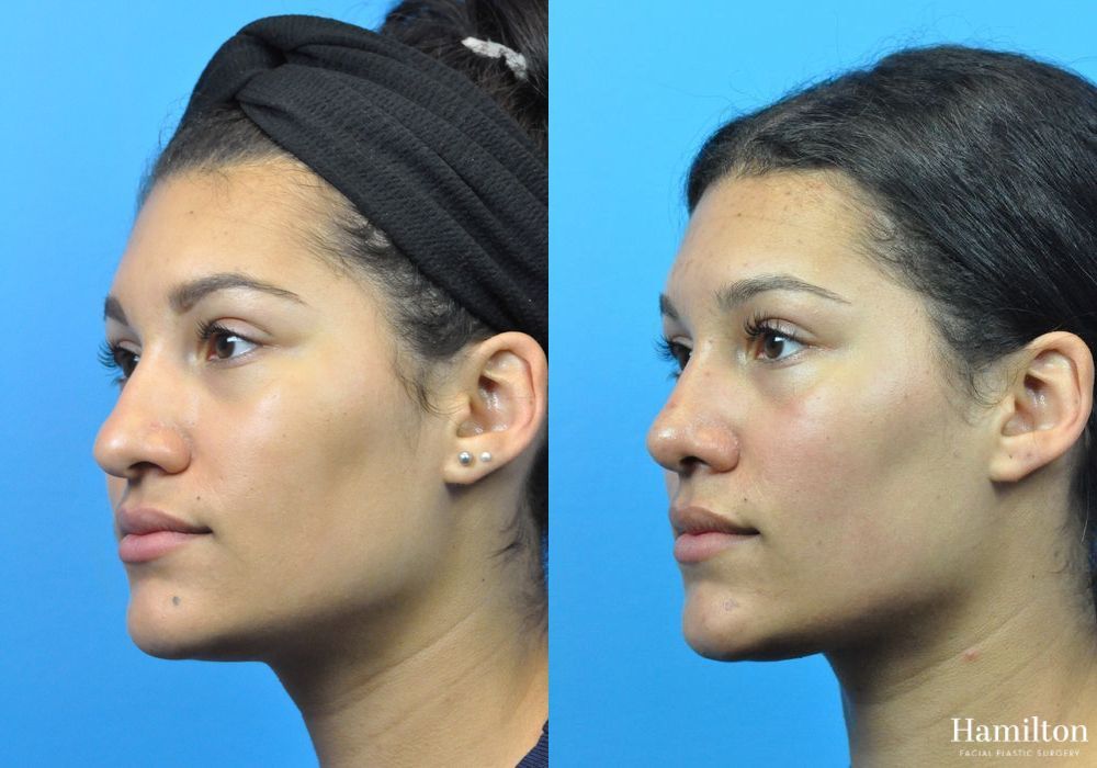 Before and after Rhinoplasty case 37331 - Angle 4