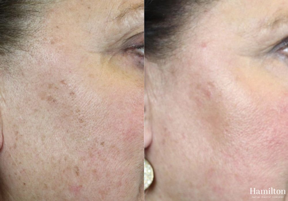 Before and after Laser - Broad Band Light (BBL) case 37240