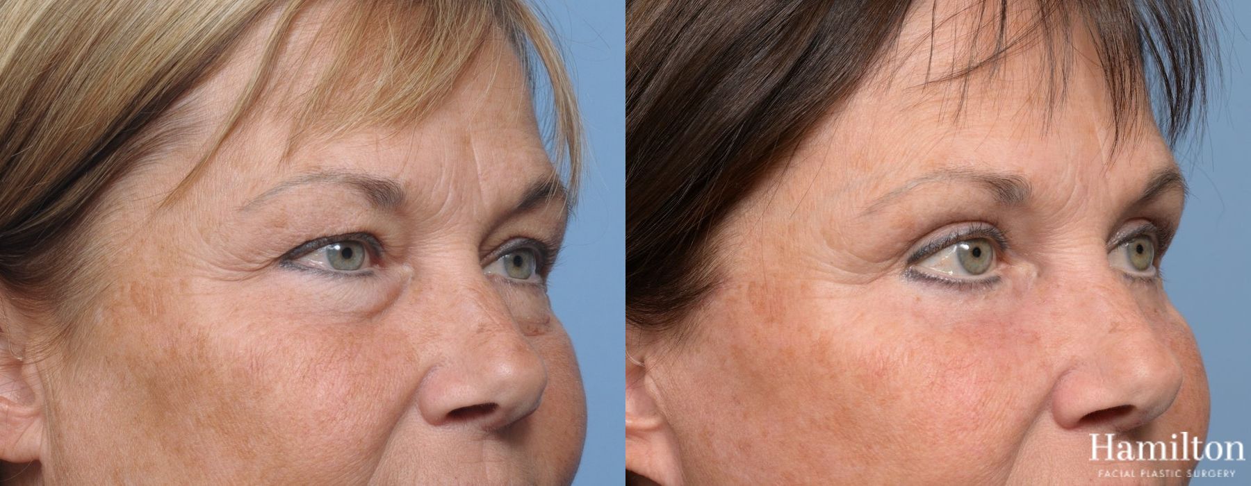 Before and after Blepharoplasty case 37256 - Angle 3