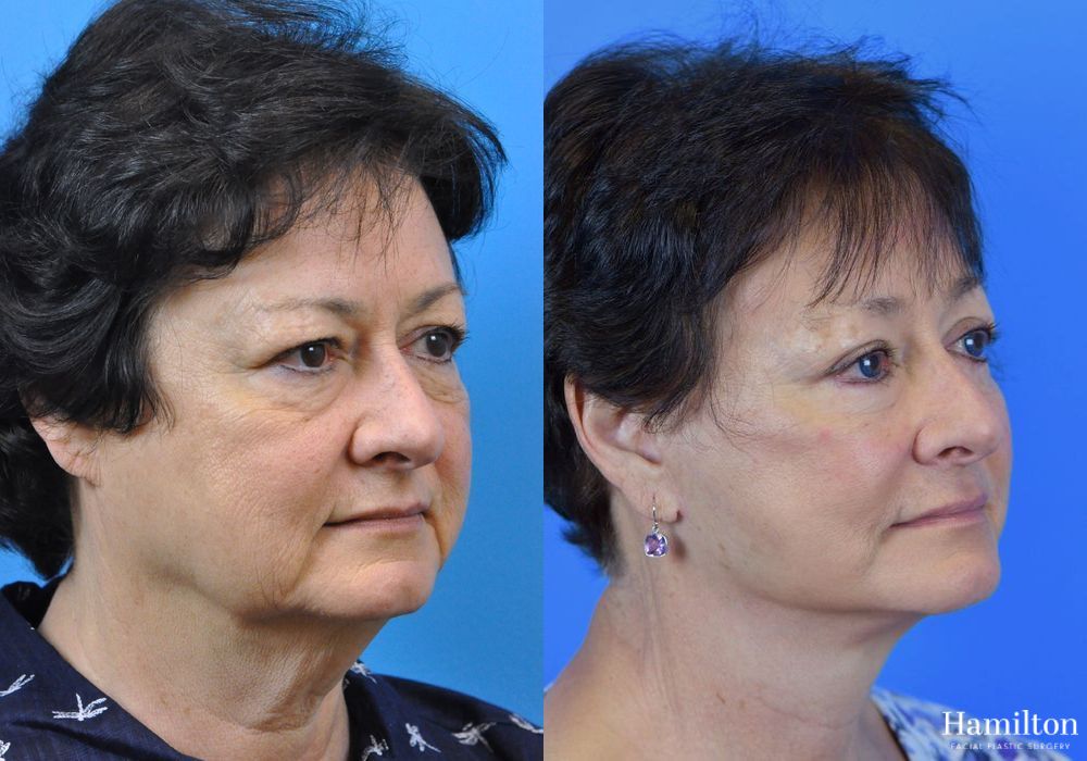 Before and after Facelift case 37296 - Angle 3