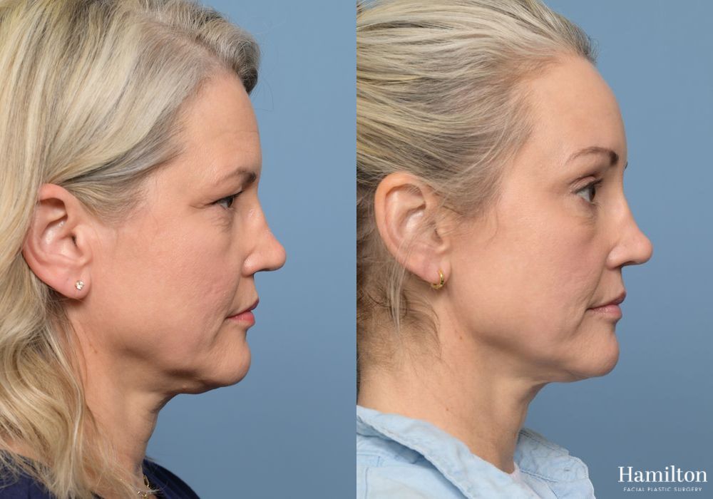 Before and after Brow Lift case 37117 - Angle 5