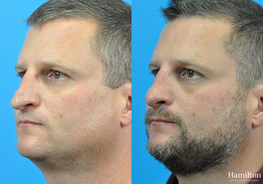 Before and after Rhinoplasty case 37312 - Angle 3