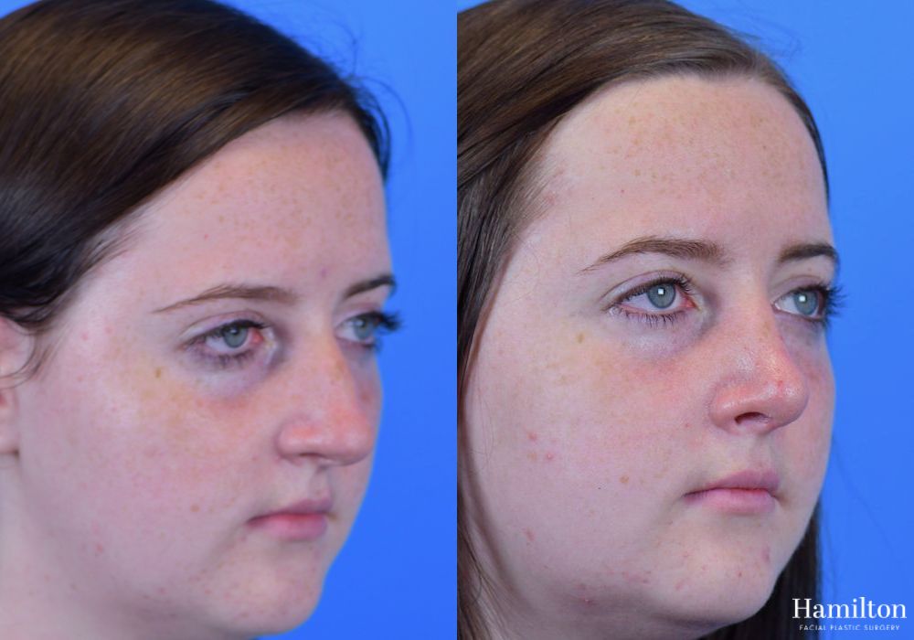 Before and after Rhinoplasty case 37339 - Angle 3