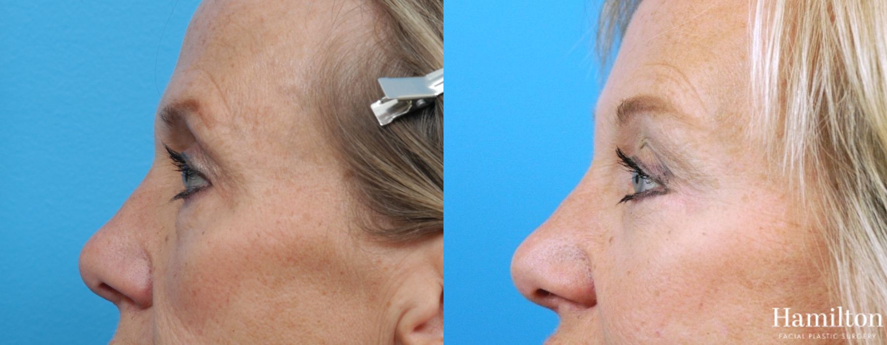 Before and after Blepharoplasty case 37216 - Angle 2