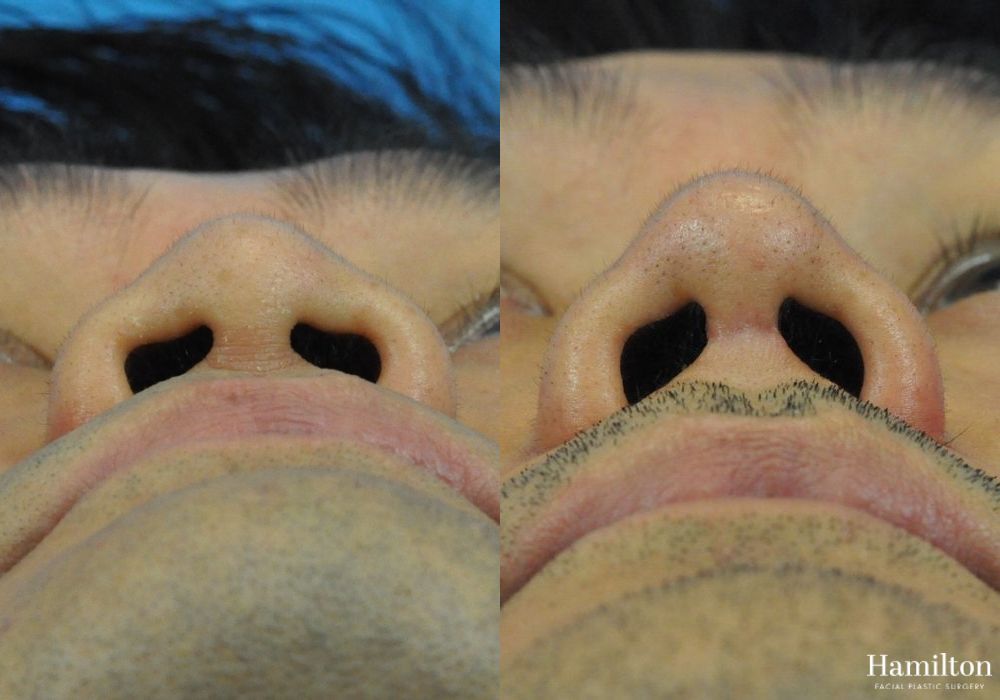 Before and after Rhinoplasty case 37288 - Angle 4