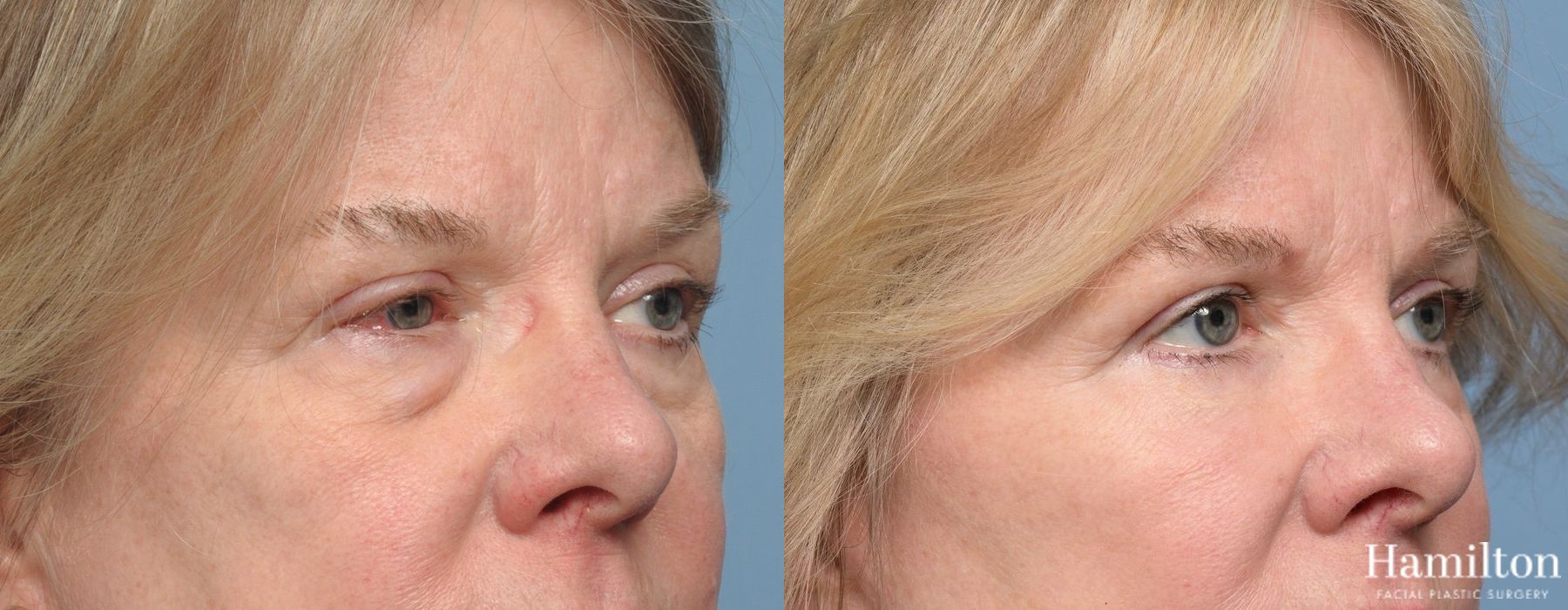 Before and after Blepharoplasty case 37230