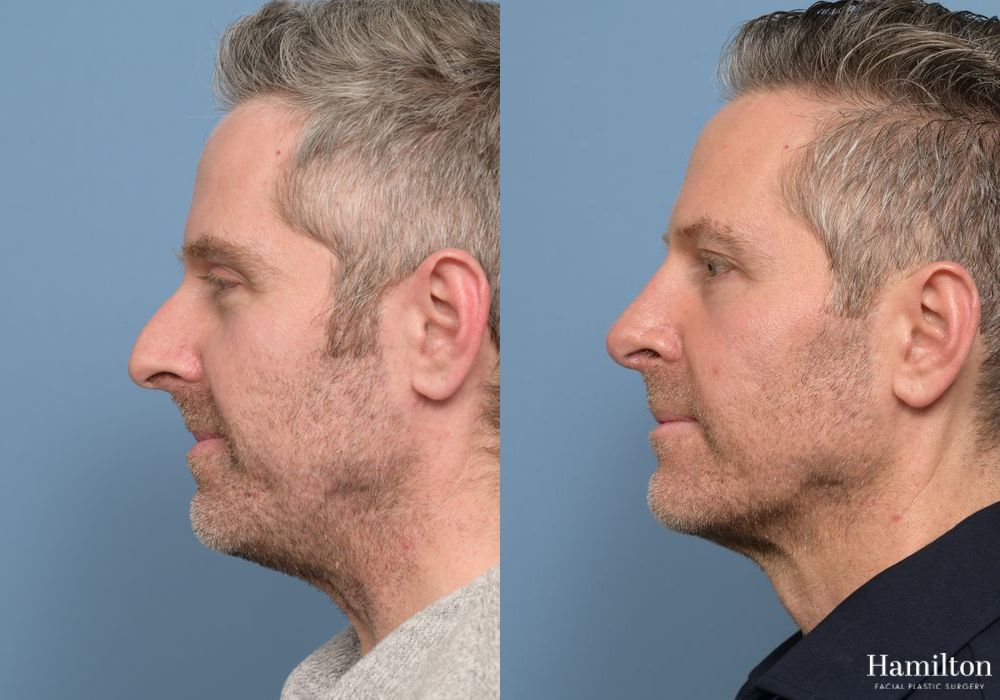 Before and after Rhinoplasty case 37134 - Angle 2