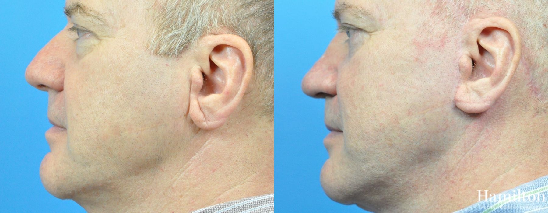 Before and after Rhinoplasty case 37264 - Angle 2