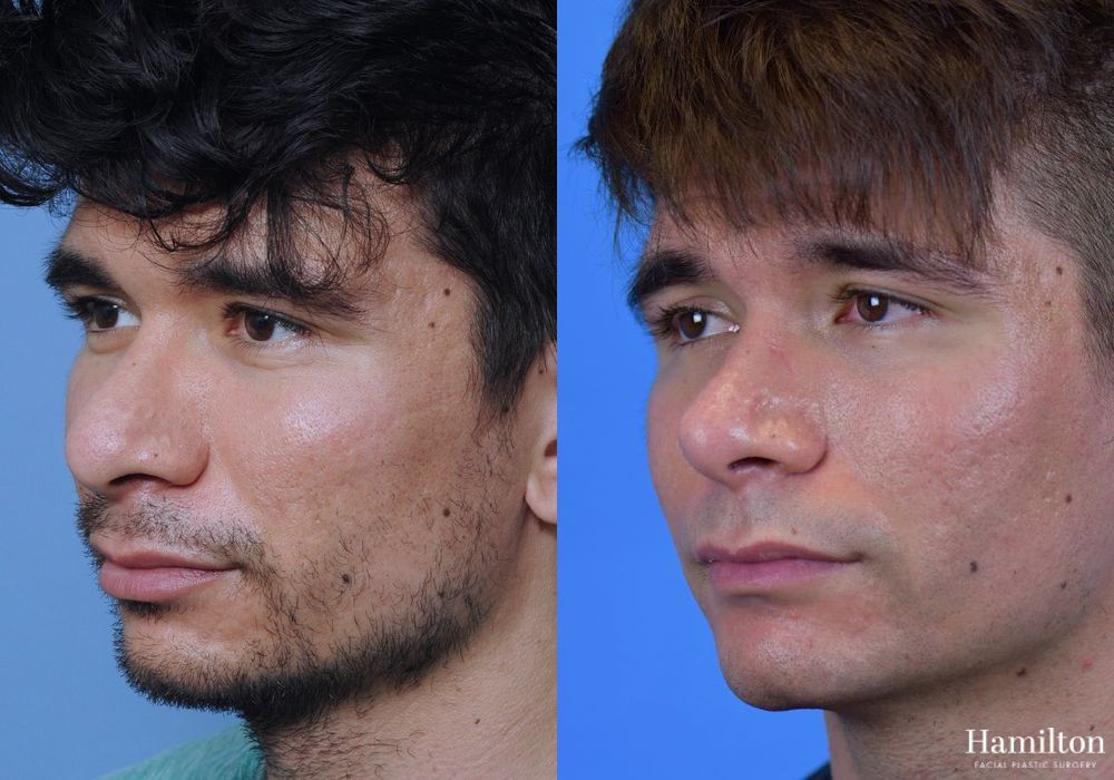 Before and after Rhinoplasty case 37271 - Angle 4