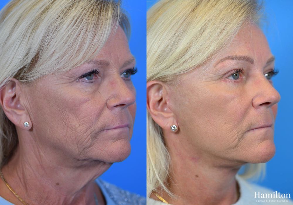 Before and after Facelift case 37233 - Angle 4
