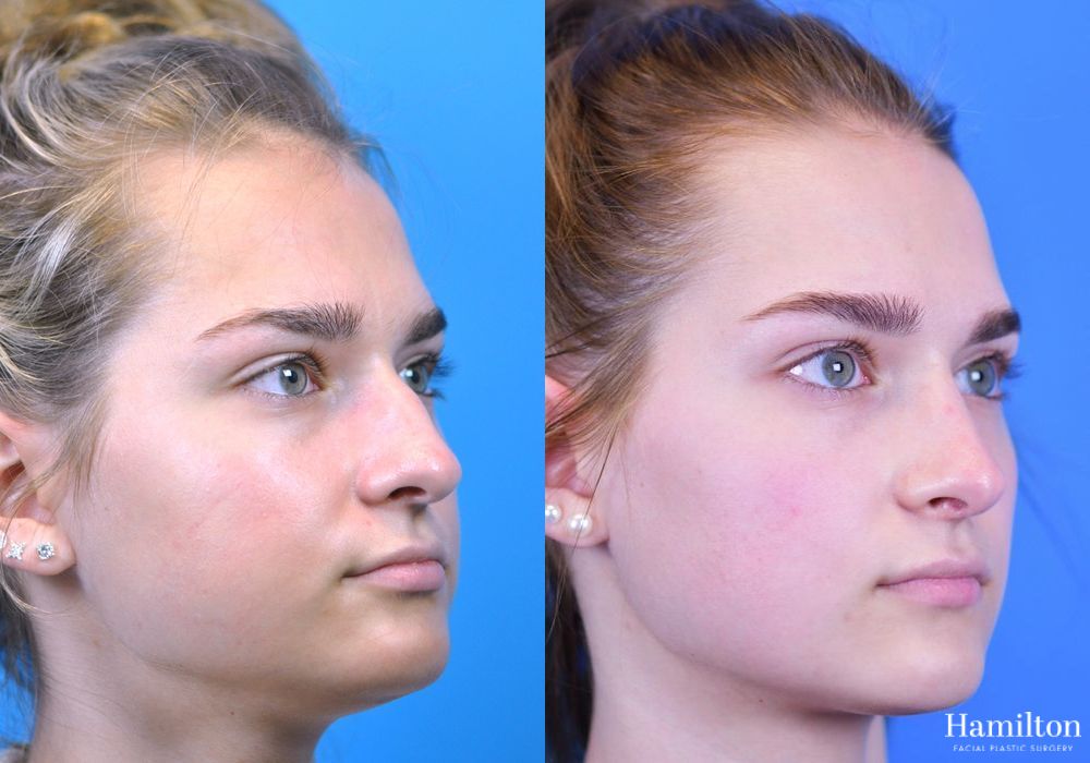 Before and after Rhinoplasty case 37251 - Angle 2