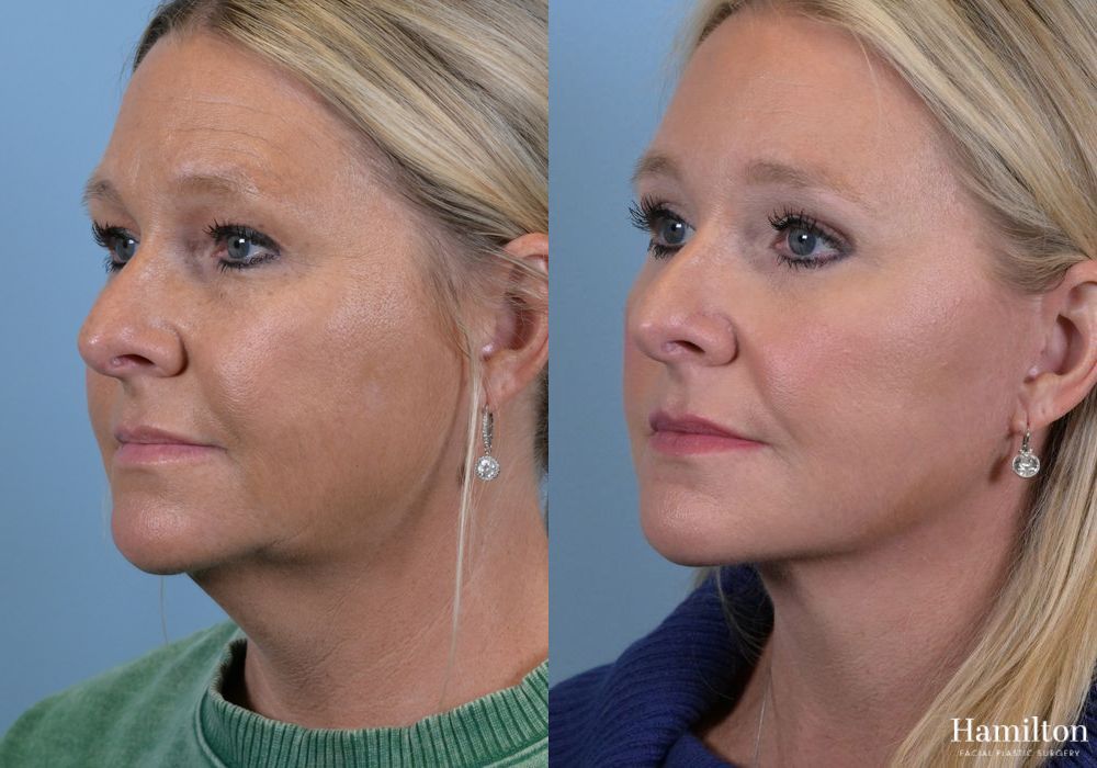 Before and after Brow Lift case 37178 - Angle 2