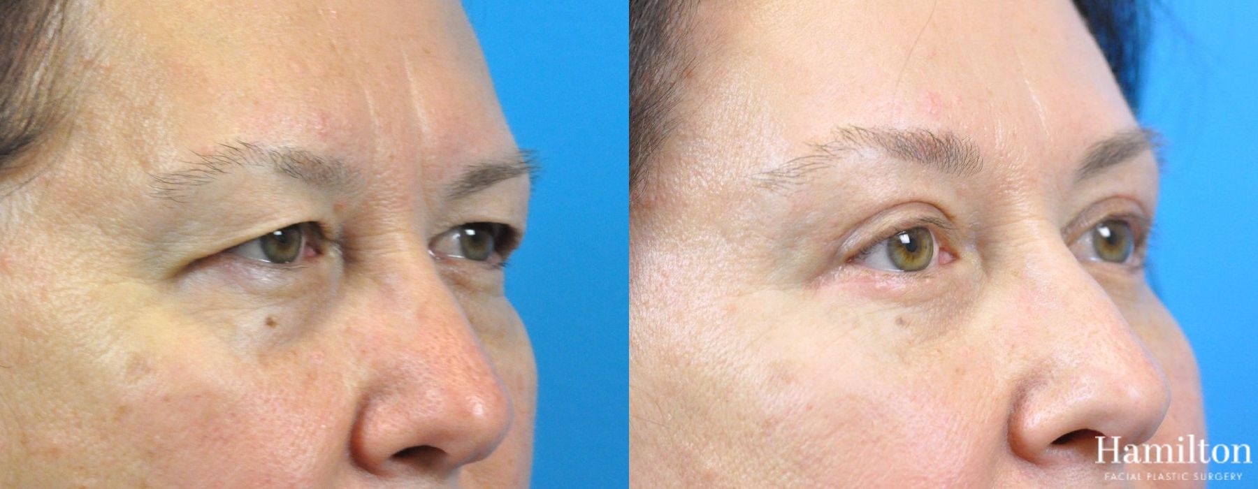 Before and after Brow Lift case 37229 - Angle 2