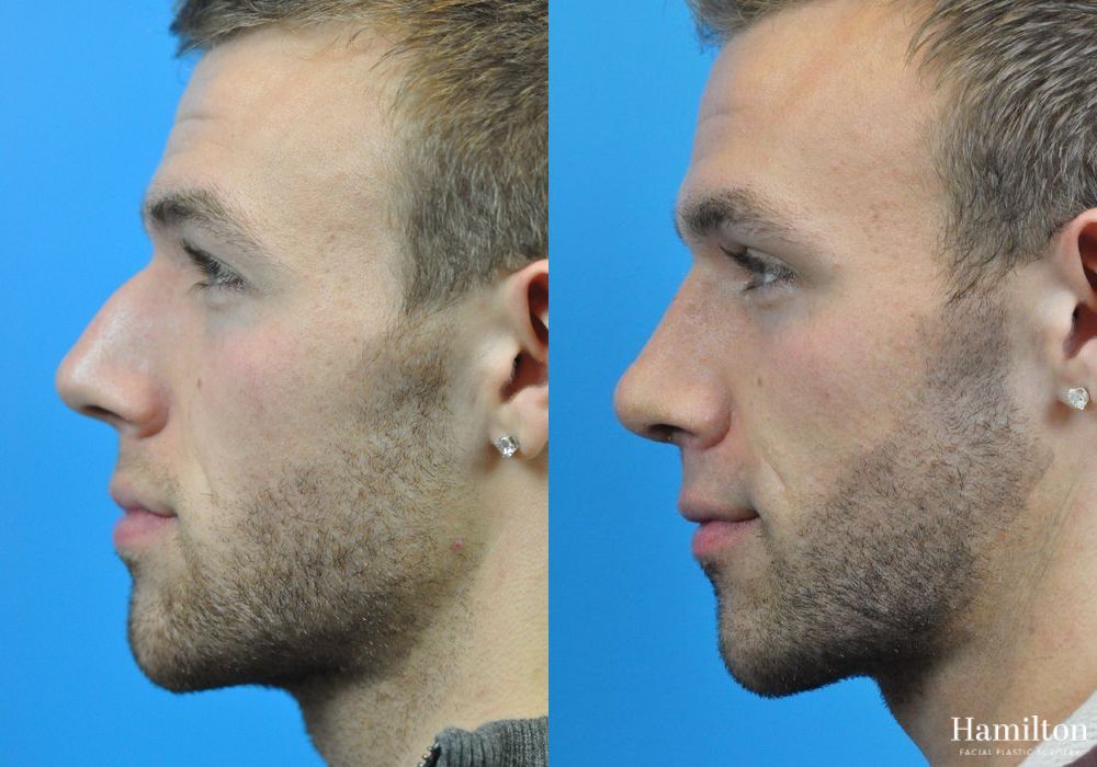 Before and after Rhinoplasty case 37250