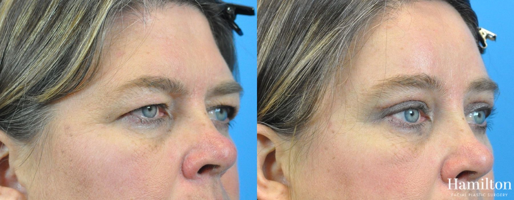 Before and after Blepharoplasty case 37272 - Angle 2