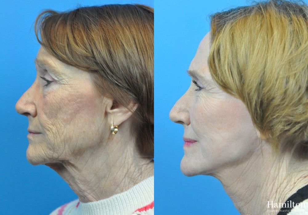 Before and after Facelift case 37320 - Angle 2