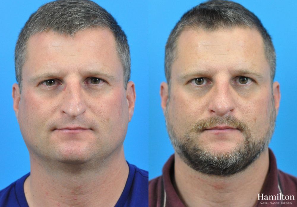 Before and after Rhinoplasty case 37312 - Angle 5