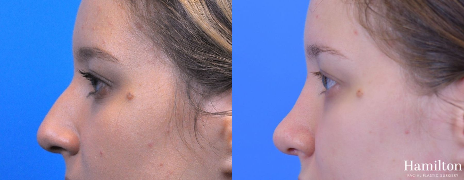 Before and after Rhinoplasty case 37269 - Angle 2