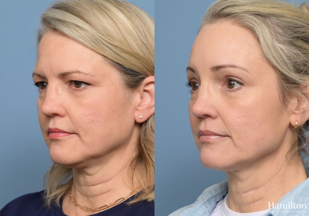 Before and after Brow Lift case 37117 - Angle 2