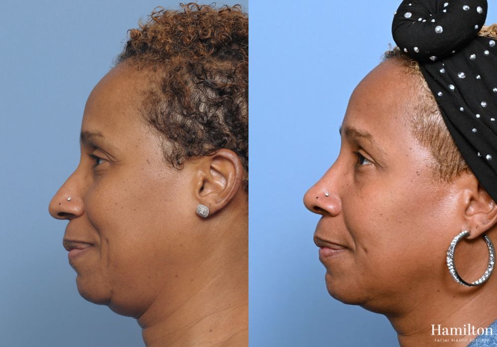 Before and after Rhinoplasty case 37298 - Angle 3