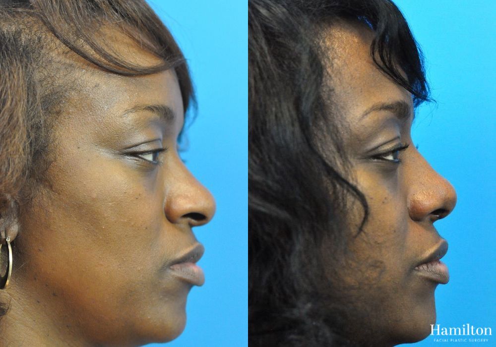 Before and after Rhinoplasty case 37295 - Angle 2