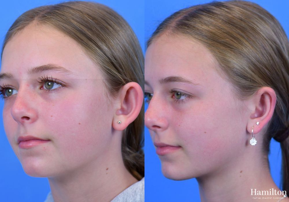 Before and after Otoplasty case 37365 - Angle 2