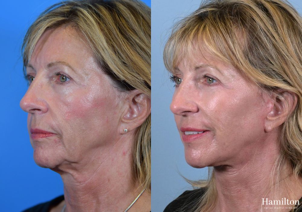 Before and after Facelift case 37279