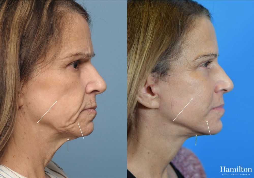 Before and after Fat Grafting case 37153