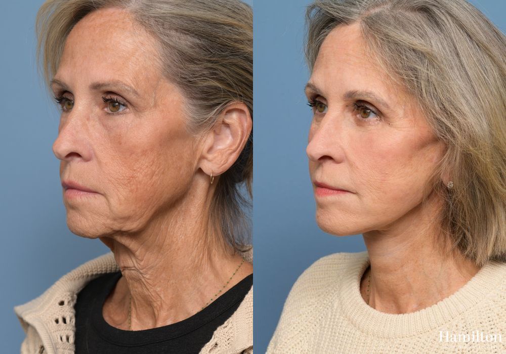 Before and after Fat Grafting case 37098 - Angle 4
