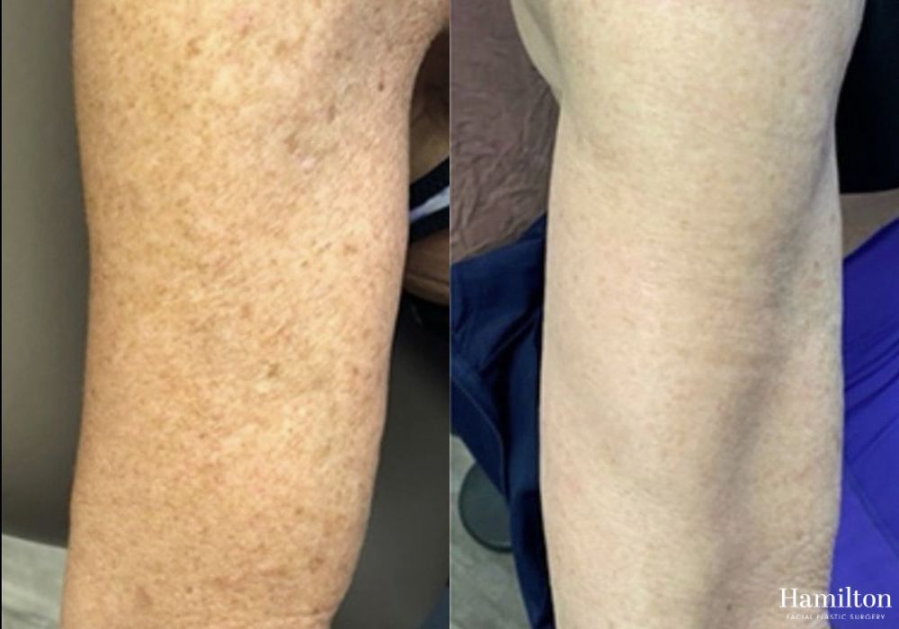 Before and after Laser - Broad Band Light (BBL) case 37180