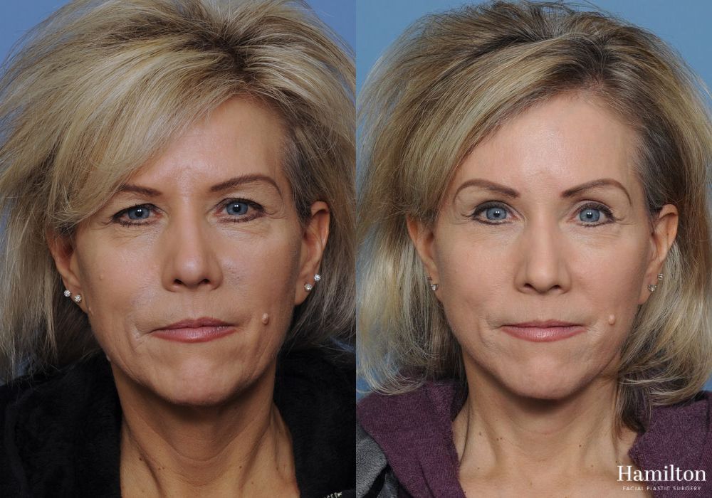 Before and after Brow Lift case 37151