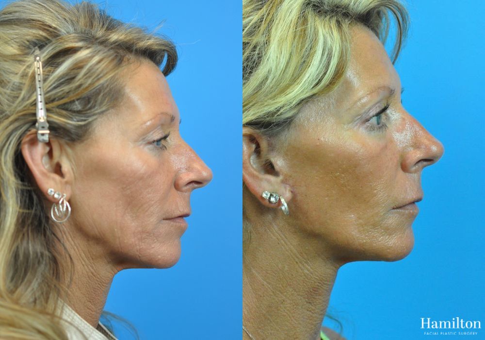 Before and after Laser - Fractional Resurfacing case 37353 - Angle 3