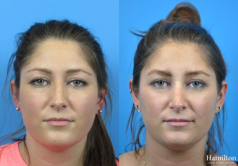 Before and after Rhinoplasty case 37313 - Angle 5