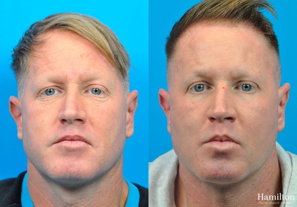 Before and after Laser - Fractional Resurfacing case 37344