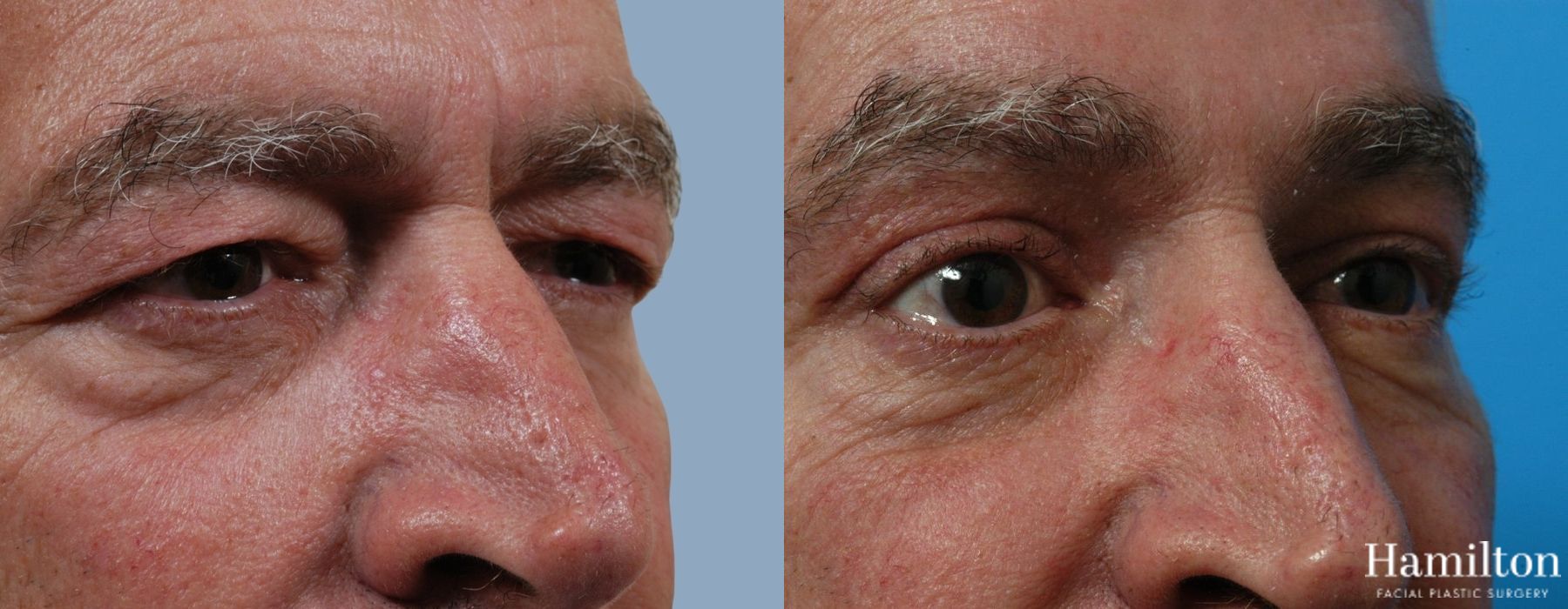 Before and after Blepharoplasty case 37280 - Angle 3