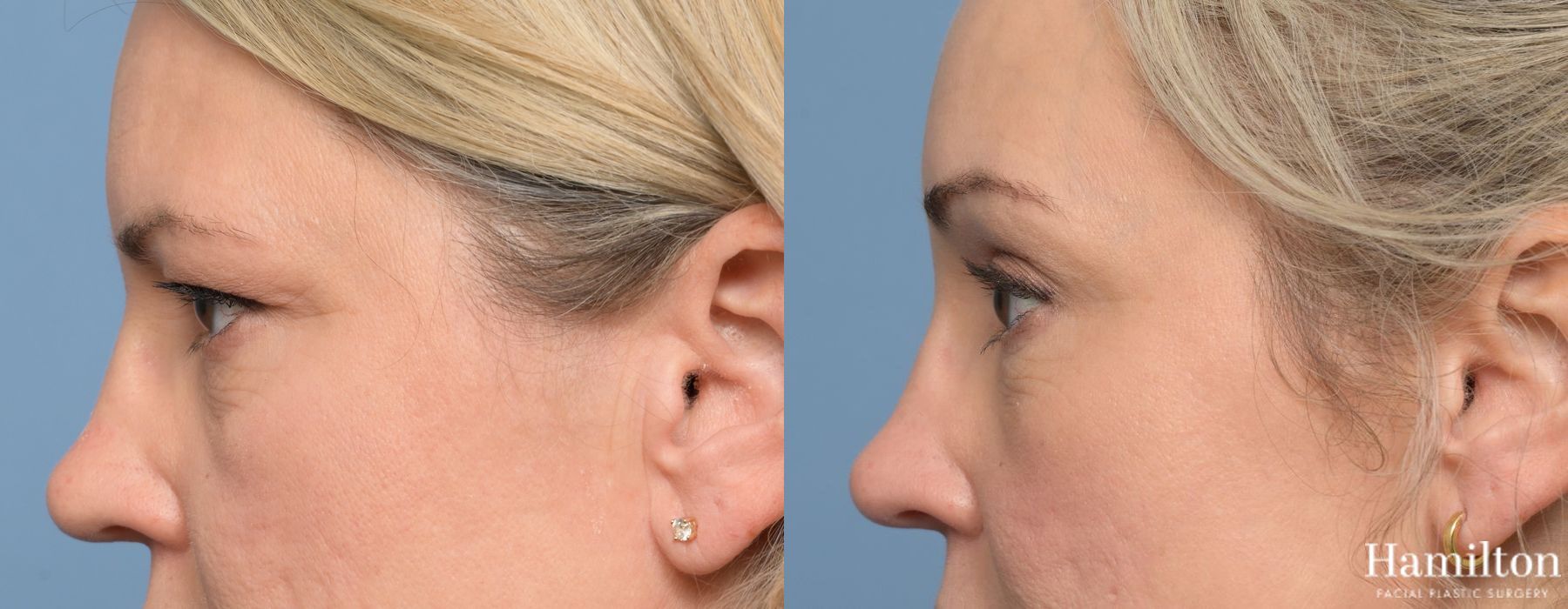 Before and after Blepharoplasty case 37175 - Angle 2